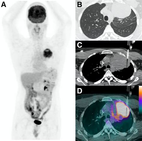 inconclusive lung biopsy results.